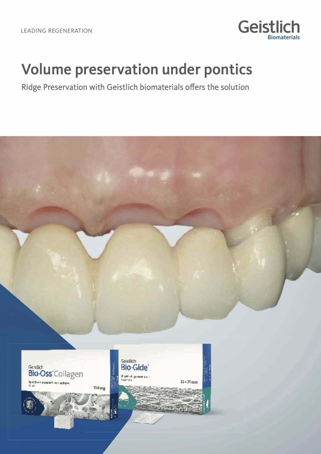 Geistlich Bio-Oss® Collagen - Volume preservation under pontics