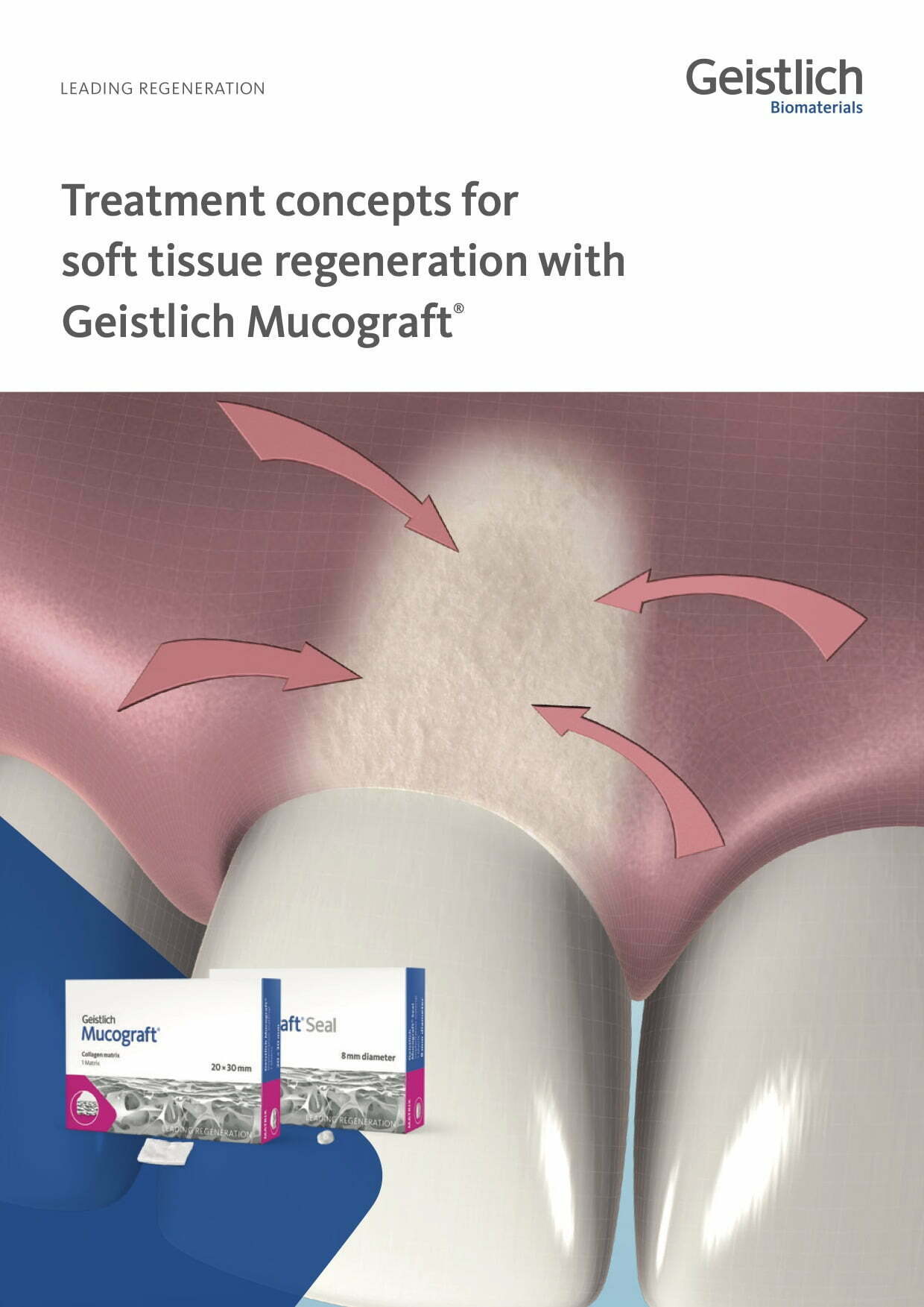 Treatment concepts – Geistlich Mucograft® & Geistlich Mucograft Seal®